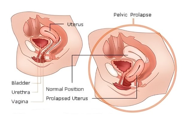 Uterine Prolapse
